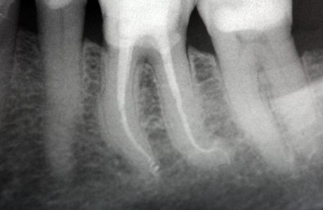 endodonzia